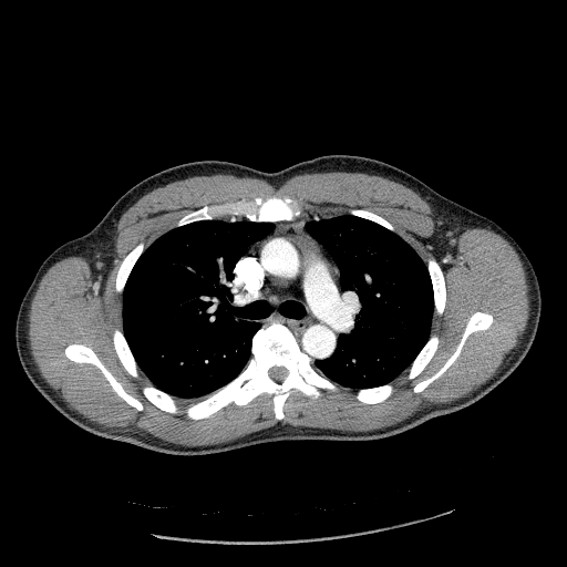 Acute segmental pulmonary emboli and pulmonary infarction (Radiopaedia 62264-70444 Axial C+ CTPA 45).jpg