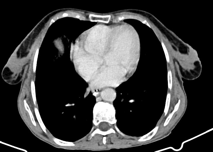 Acute small bowel (ileal) volvulus (Radiopaedia 71740-82139 Axial C+ portal venous phase 28).jpg