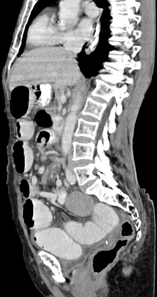 Acute small bowel (ileal) volvulus (Radiopaedia 71740-82139 Sagittal C+ portal venous phase 92).jpg