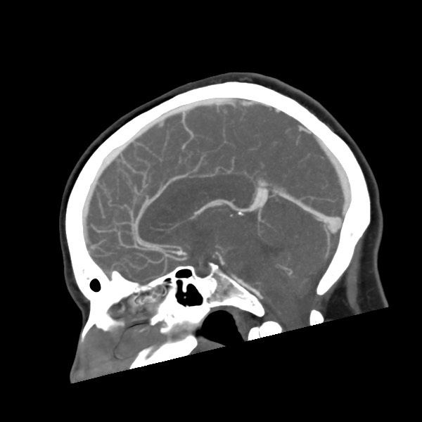 Acute subarachnoid hemorrhage and accessory anterior cerebral artery (Radiopaedia 69231-79009 Sagittal C+ arterial phase 38).jpg
