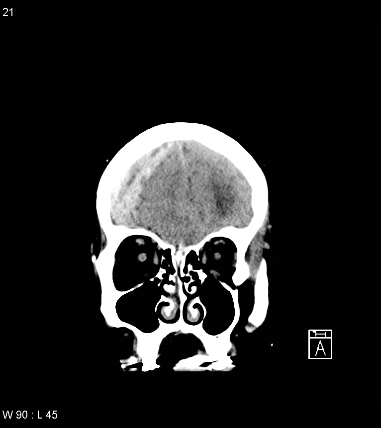 Acute subdural hematoma with myelofibrosis (Radiopaedia 52582-58494 Coronal non-contrast 12).jpg