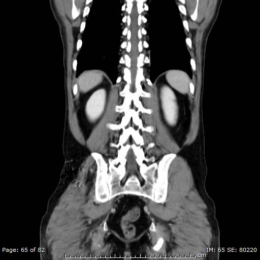 Acute superior mesenteric artery occlusion (Radiopaedia 43636-47060 Coronal C+ portal venous phase 50).jpg