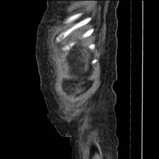 Acute tubular necrosis (Radiopaedia 28077-28334 Sagittal non-contrast 10).jpg