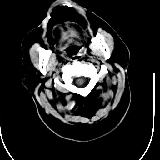 Acute vertebrobasilar ischemic infarction (Radiopaedia 25220-25473 Axial non-contrast 2).jpg