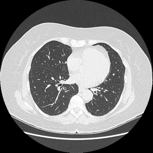 Adenocarcinoma in situ of lung (Radiopaedia 38685-40829 B 164).png