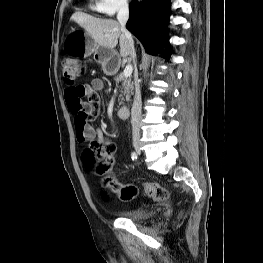Adenocarcinoma of colon with entero-colic fistula (Radiopaedia 22832-22852 Sagittal C+ portal venous phase 29).jpg