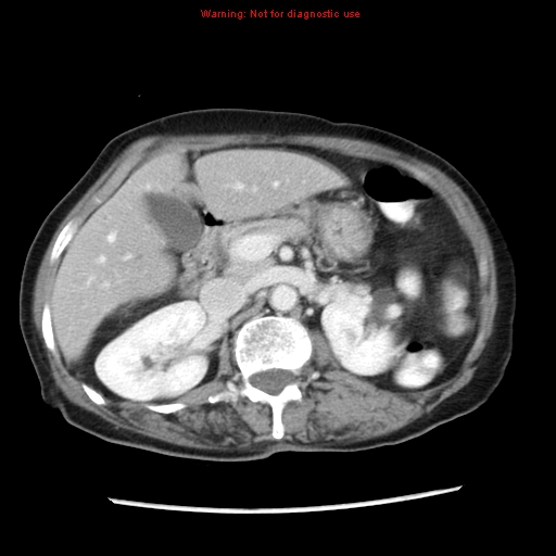 Adenocarcinoma of the colon (Radiopaedia 8191-9039 Axial liver window 27).jpg