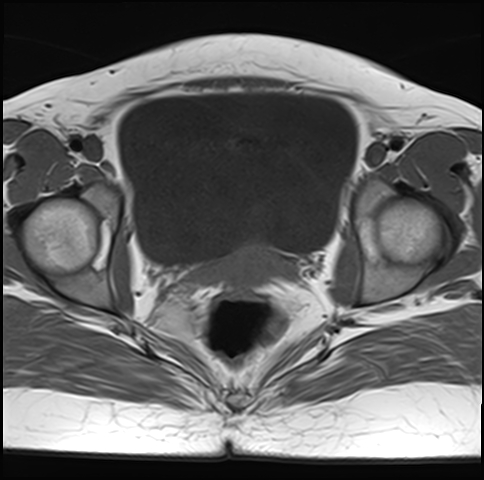 File:Adenomyosis - ovarian endometriomas (Radiopaedia 67031-76350 Axial T1 20).jpg
