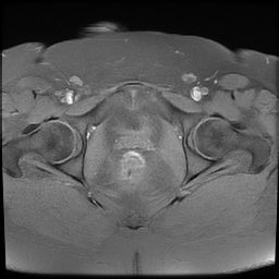 File:Adenomyosis within a didelphys uterus (Radiopaedia 70175-80215 Axial T1 fat sat 34).jpg