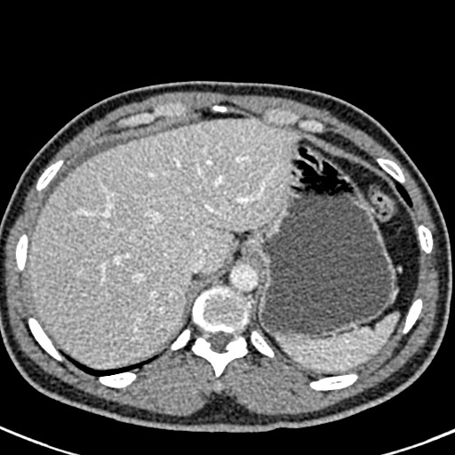 Adhesional small bowel obstruction (Radiopaedia 58900-66131 Axial C+ portal venous phase 9).jpg