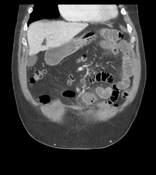 Adhesions within abdominal wall hernia (Radiopaedia 58283-65394 Coronal C+ portal venous phase 23).png