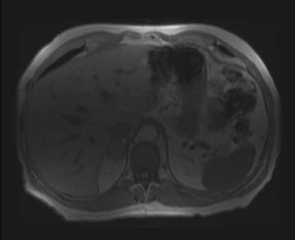 File:Adrenal adenoma (Radiopaedia 11172-42397 Axial T1 in-phase 1).jpg