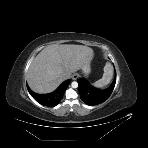 Adrenal angiosarcoma (Radiopaedia 81081-94671 Axial C+ arterial phase 11).jpg