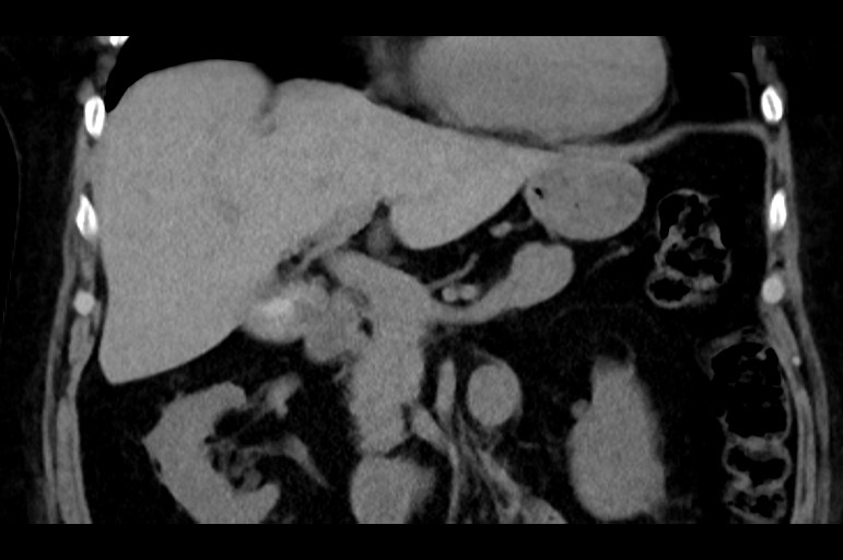 Adrenal cortical carcinoma (Radiopaedia 64017-72769 Coronal non-contrast 24).jpg