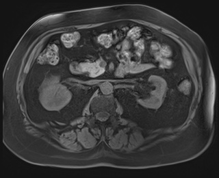 Adrenal cortical carcinoma (Radiopaedia 64017-72770 Axial T1 fat sat 41).jpg