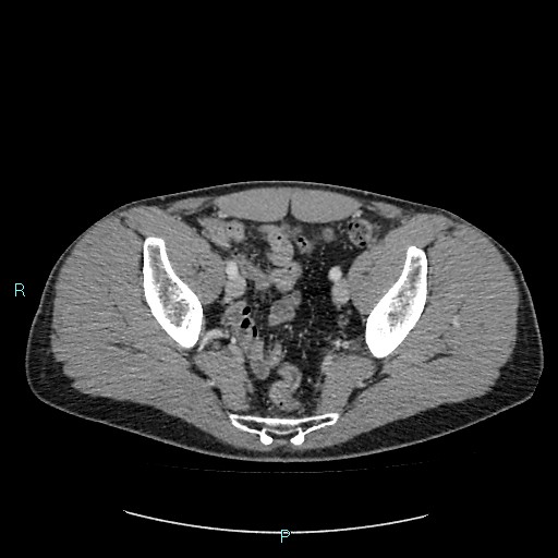 File:Adrenal cystic lymphangioma (Radiopaedia 83161-97534 Axial C+ portal venous phase 84).jpg