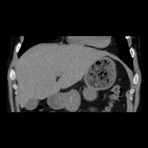 Adrenal gland trauma (Radiopaedia 81351-95079 Coronal non-contrast 27).jpg