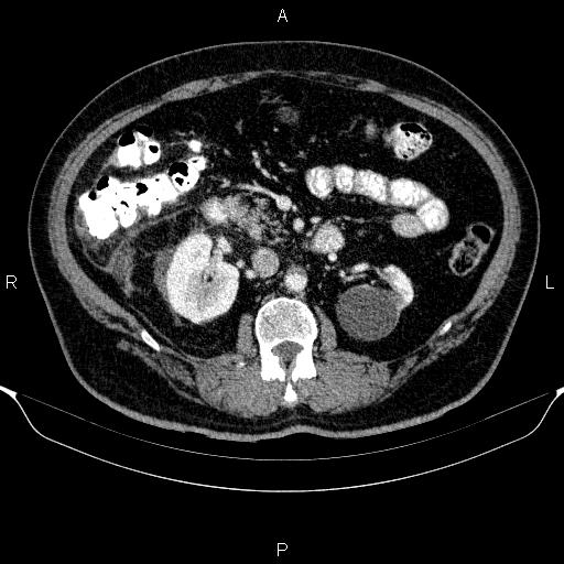 Adrenal hemorrhage (Radiopaedia 62622-70916 Axial C+ portal venous phase 80).jpg