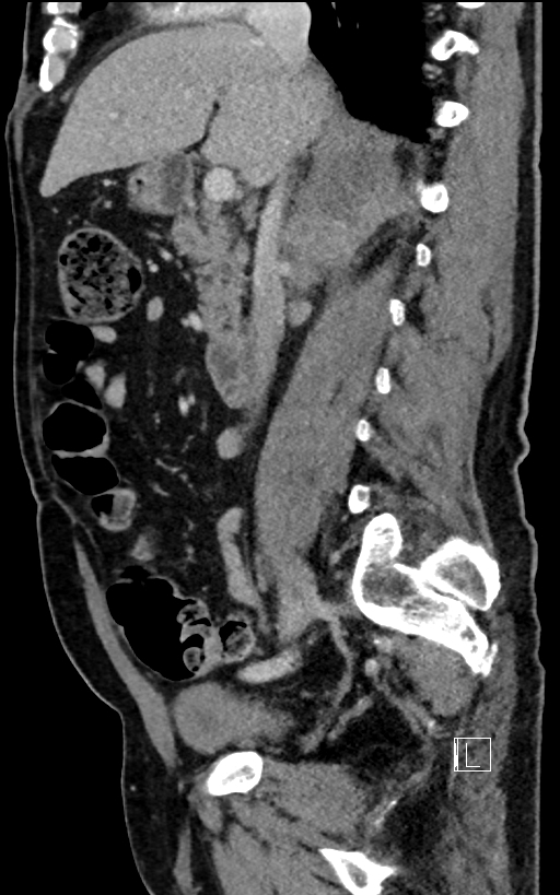 Adrenal lymphoma (Radiopaedia 73730-84529 Sagittal C+ portal venous phase 48).jpg