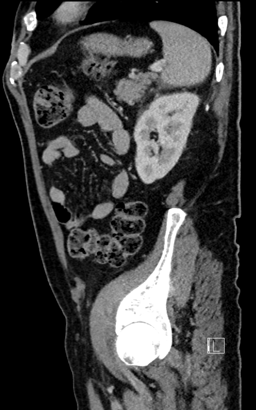 Adrenal lymphoma (Radiopaedia 73730-84529 Sagittal C+ portal venous phase 85).jpg