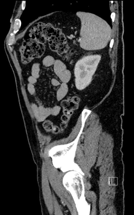 Adrenal lymphoma (Radiopaedia 73730-84529 Sagittal C+ portal venous phase 90).jpg