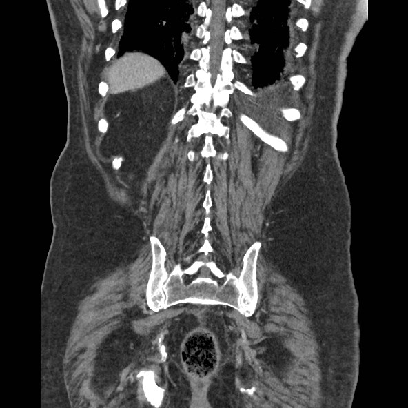 Adrenal lymphoma (Radiopaedia 84145-99415 Coronal C+ portal venous phase 74).jpg