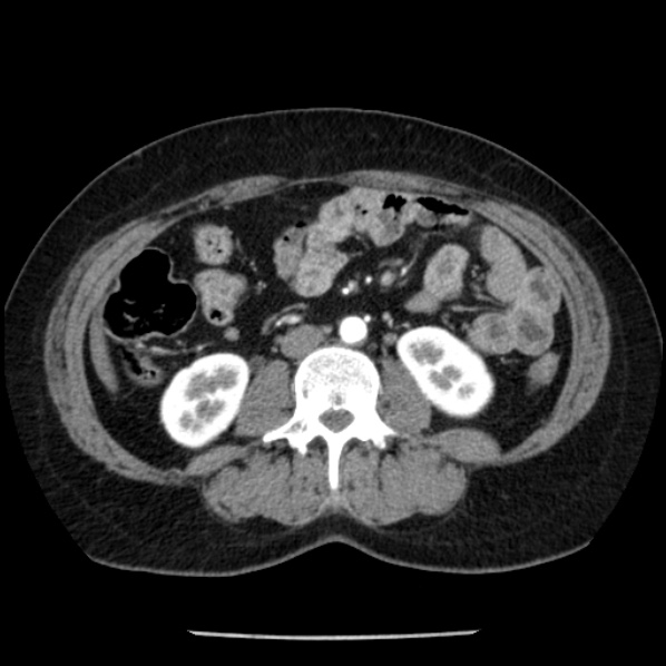 Adrenal myelolipoma (Radiopaedia 43401-46759 Axial C+ arterial phase 54).jpg