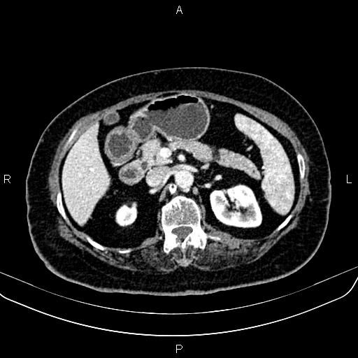 File:Adrenal myelolipoma (Radiopaedia 82742-96986 Axial renal cortical phase 63).jpg