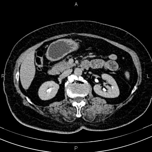 Adrenal myelolipoma (Radiopaedia 82742-96986 Axial renal excretory phase 60).jpg