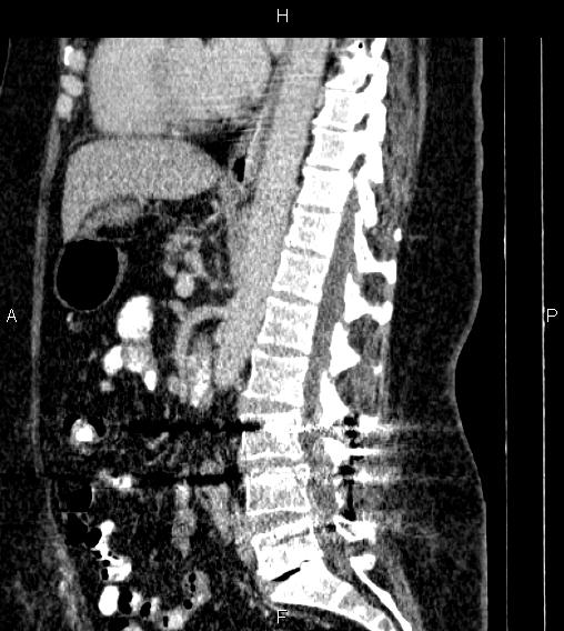 Adrenal myelolipoma (Radiopaedia 84319-99617 Sagittal renal cortical phase 51).jpg