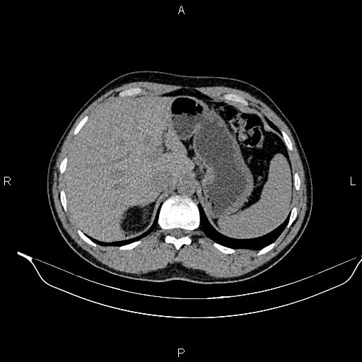 Adrenal myelolipoma (Radiopaedia 87794-104246 Axial non-contrast 24).jpg