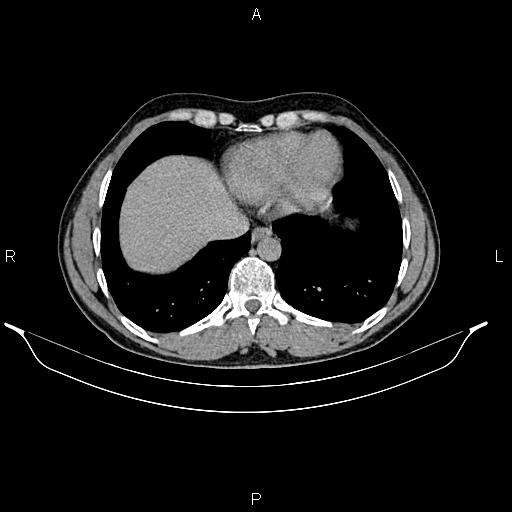 Adrenal myelolipoma (Radiopaedia 87794-104246 Axial renal excretory phase 10).jpg