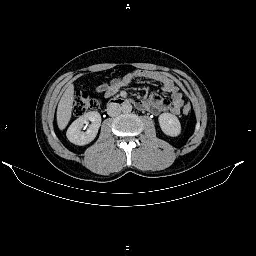 Adrenal myelolipoma (Radiopaedia 87794-104246 Axial renal excretory phase 48).jpg