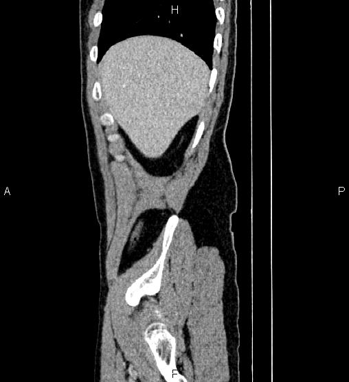 Adrenal myelolipoma (Radiopaedia 87794-104246 Sagittal renal cortical phase 11).jpg