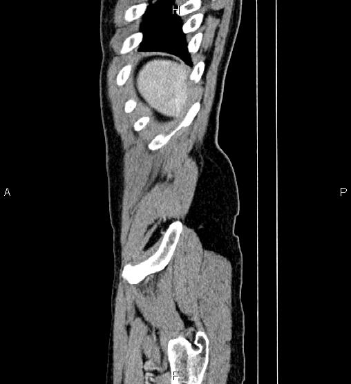 Adrenal myelolipoma (Radiopaedia 87794-104246 Sagittal renal cortical phase 90).jpg