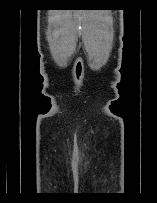 Adrenal myelolipoma - bilateral (Radiopaedia 74805-85810 Coronal C+ portal venous phase 38).jpg