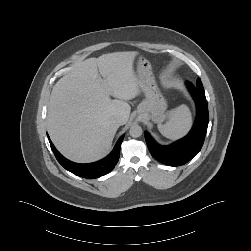 File:Adrenal vein sampling and adrenal nodular hyperplasia - Conn syndrome (Radiopaedia 30561-31337 Axial non-contrast 10).jpg