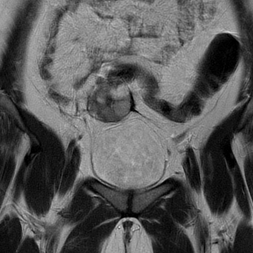 File:Adult granulosa cell tumor of the ovary (Radiopaedia 64991-73953 Coronal T2 5).jpg