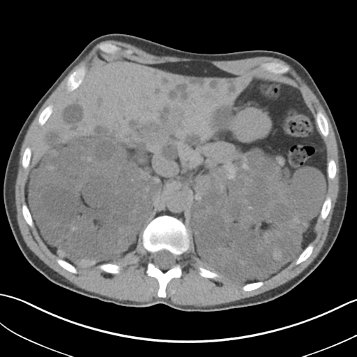 Adult polycystic kidney disease (Radiopaedia 47866-52626 Axial non-contrast 21).png
