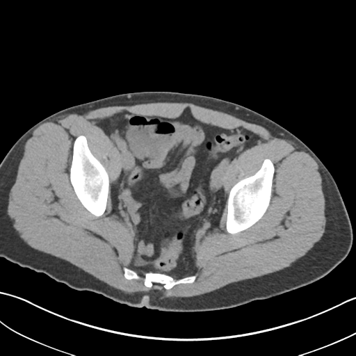 File:Adult polycystic kidney disease (Radiopaedia 47866-52626 Axial non-contrast 73).png