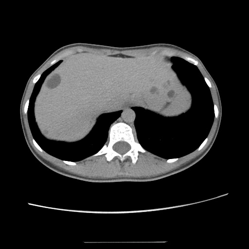 Adult polycystic kidney disease (Radiopaedia 48845-53876 Axial renal excretory phase 21).jpg