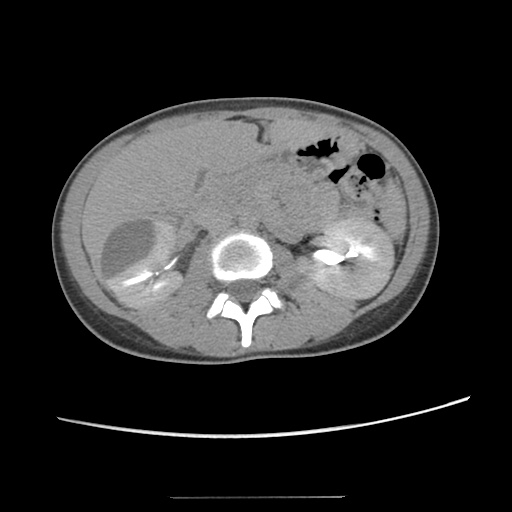 Adult polycystic kidney disease (Radiopaedia 48845-53876 Axial renal excretory phase 40).jpg