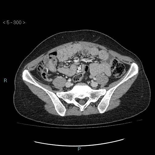 Adult transient intestinal intussusception (Radiopaedia 34853-36310 Axial C+ portal venous phase 70).jpg