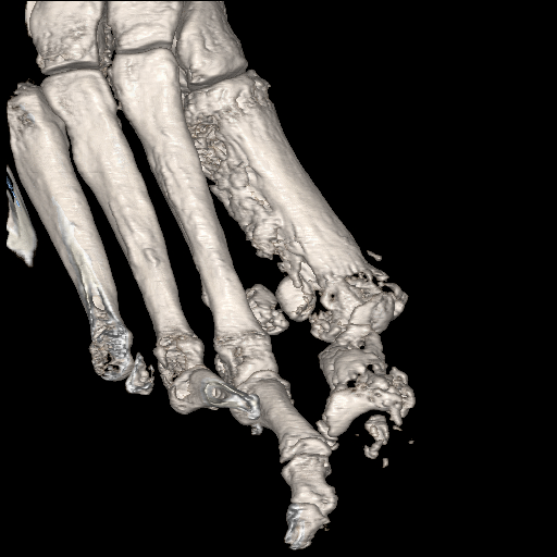 File:Advanced osteomyelitis due to open metatarsal fracture (Radiopaedia 83891-99095 VRT 15).jpg