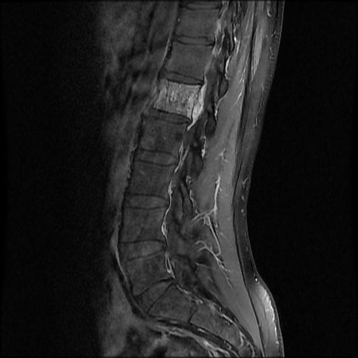 File:Aggressive vertebral hemangioma with pathological fracture (Radiopaedia 69528-79411 F 7).jpg