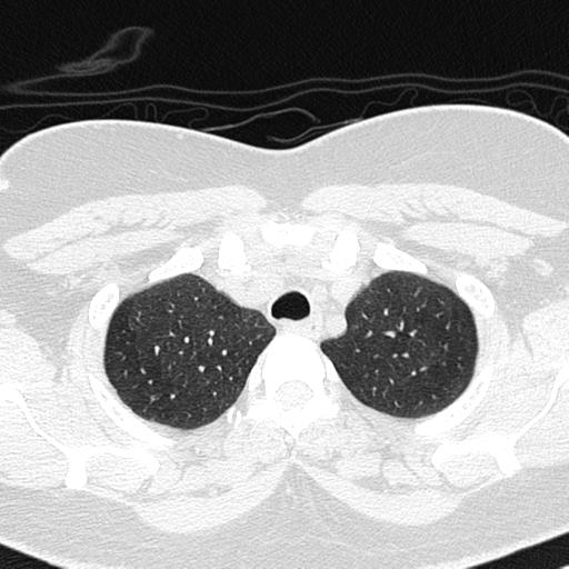 Air trapping in small airway disease (Radiopaedia 61685-69694 Axial lung window 28).jpg