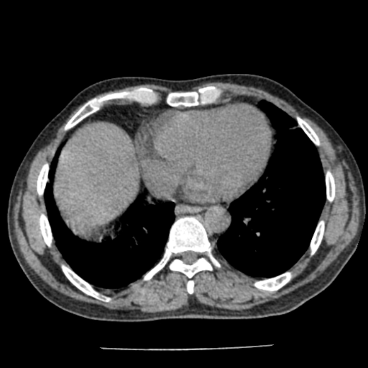 Airway foreign body in adult (Radiopaedia 85907-101779 Axial liver window 132).jpg