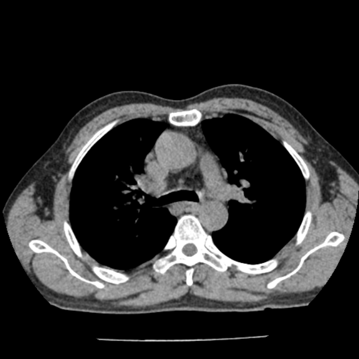 Airway foreign body in adult (Radiopaedia 85907-101779 Axial liver window 55).jpg