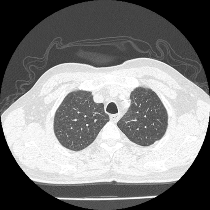 Airway foreign body in adult (Radiopaedia 85907-101779 Axial lung window 19).jpg