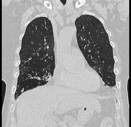 File:Alpha-1-antitrypsin deficiency (Radiopaedia 72058-82557 Coronal lung window 20).jpg